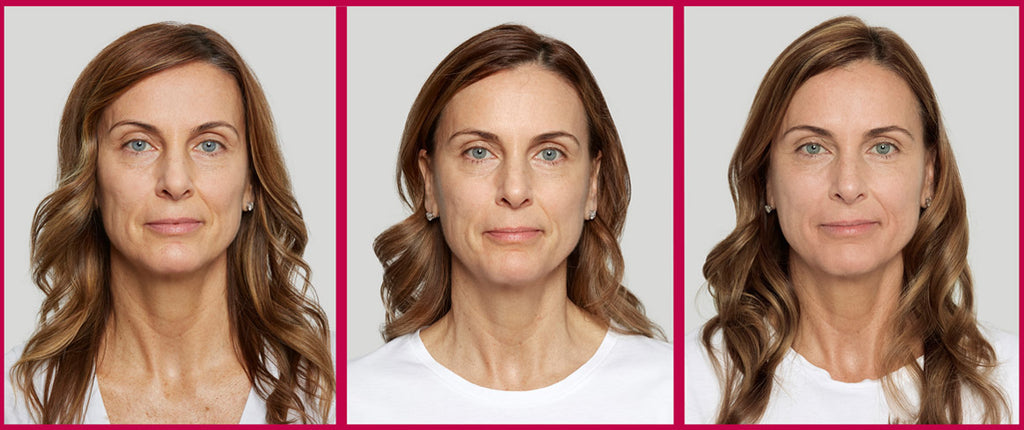 Considering fillers?  Explore Sculptra for balanced results!