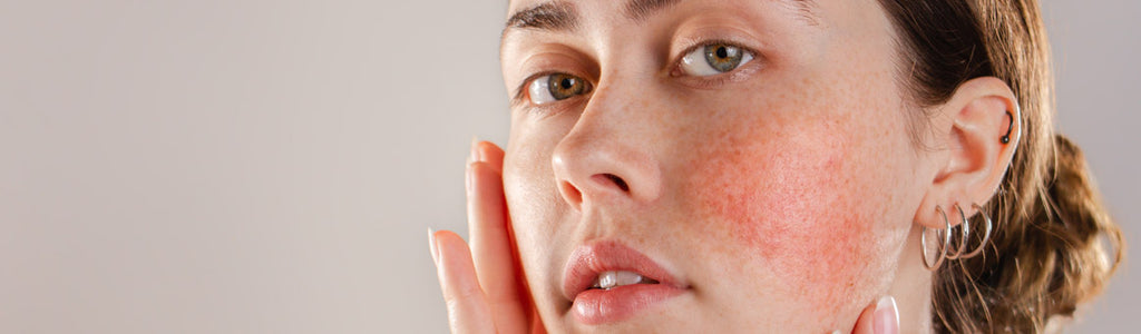 What Is Rosacea, and How Do You Treat it?